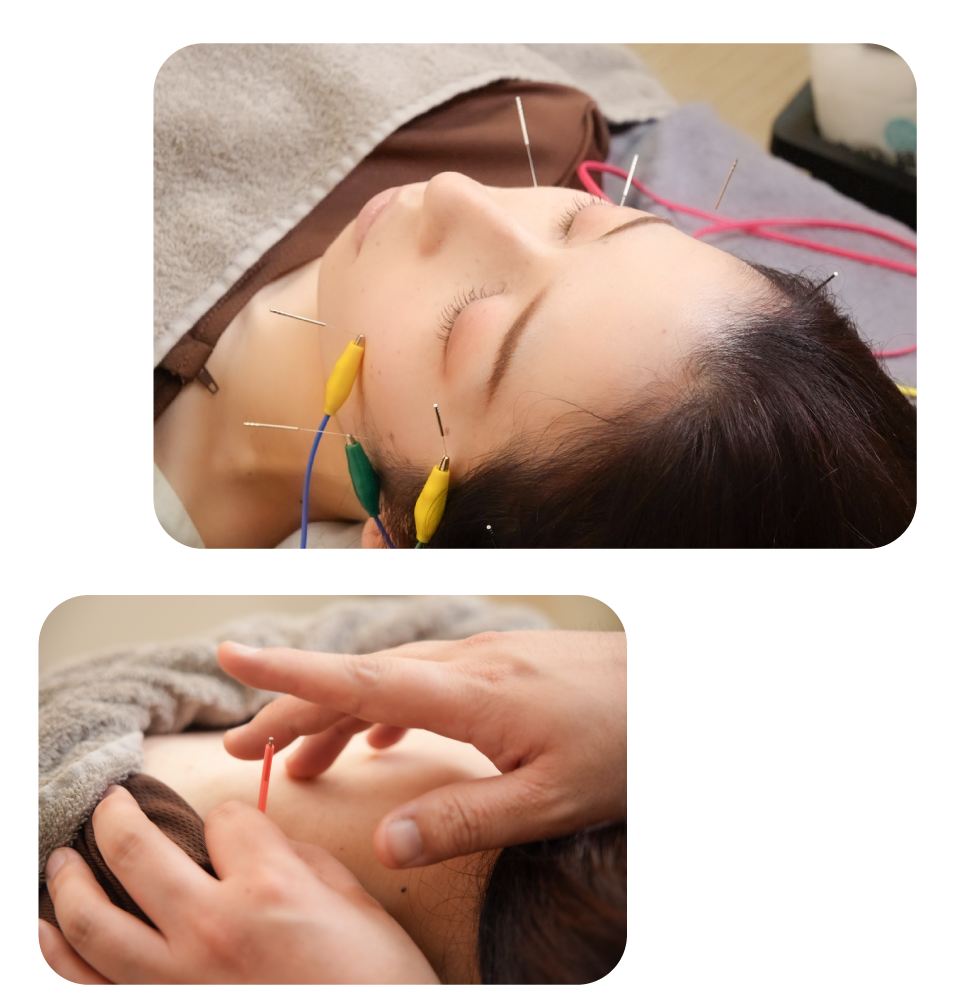 「はり」による施術を美容に応用したのが「美容鍼」。<br />エステやフェイシャルサロンなどで行える外側からのアプローチに加えて、「はり」を使うことで肌の内側にも働きかけていくことができます。<br />また、電気刺激を組み合わせることで普段は動かすことが少ないような表情筋にもアプローチ。<br />筋肉への刺激で表情筋を鍛え、お顔の引き締めを目指します。